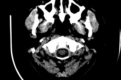 CT Scan of a Head